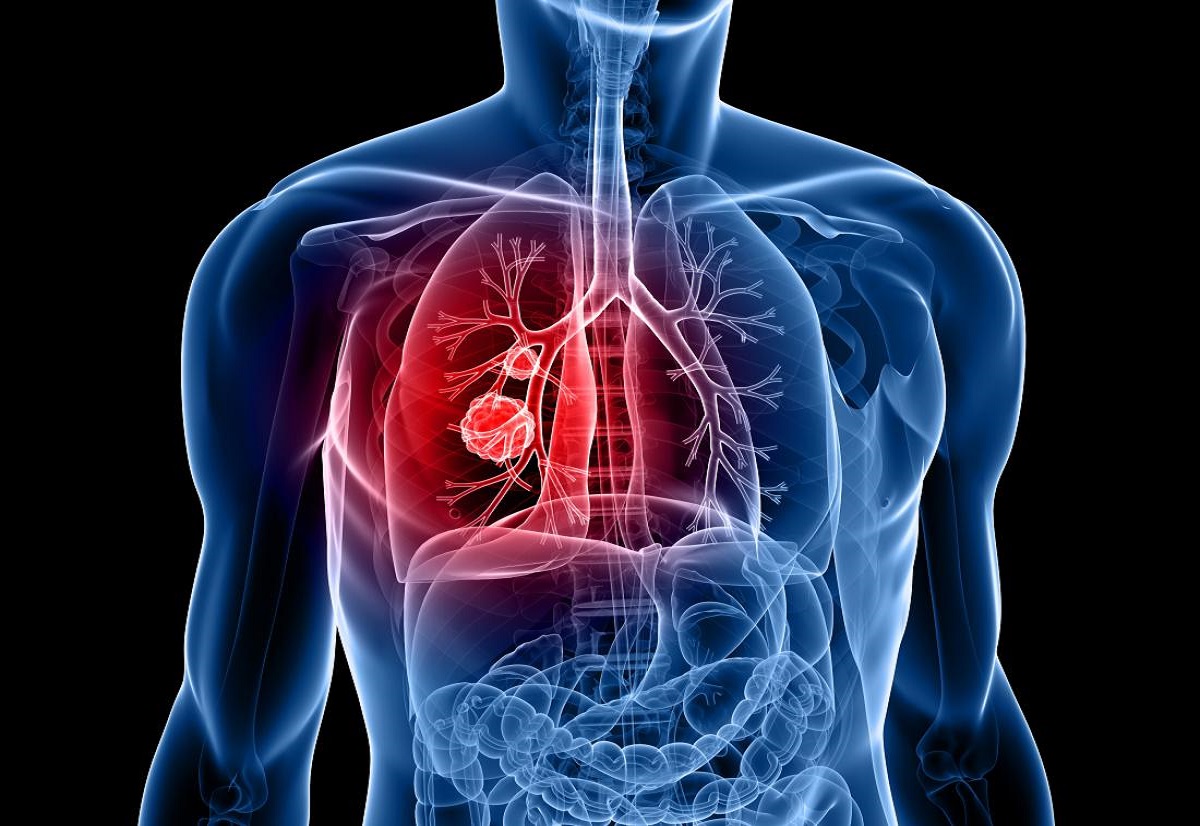 Recognizing Early Warning Signs: Could Minor Symptoms Indicate Cancer?”